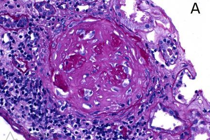 Chronic Lesions of ANCA - Fibrous Crescent