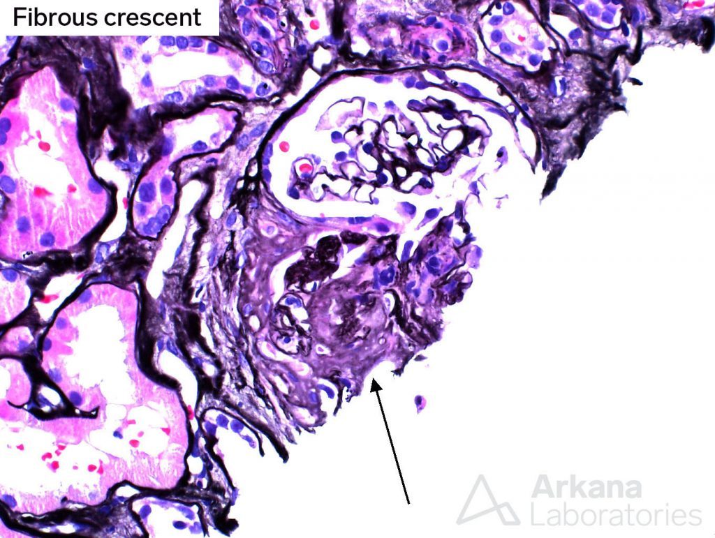 Glomeruli, atypical pattern, segmental sclerosis, fibrous crescent, arkana laboratories