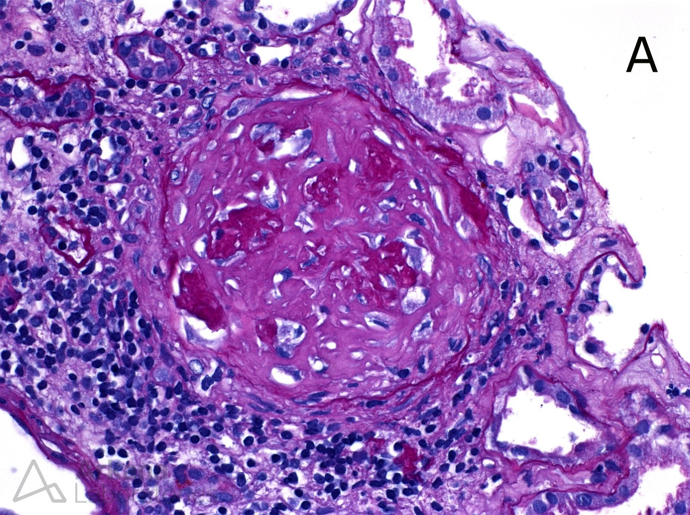 Chronic Lesions of ANCA - Fibrous Crescent