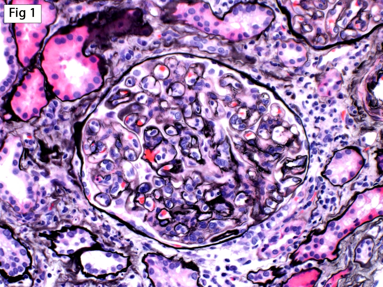 Antibody-Mediated Rejection