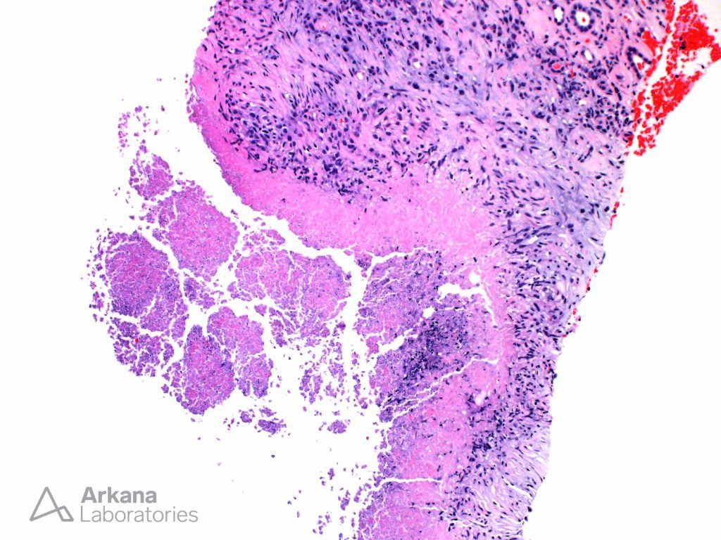 Caseating Granuloma