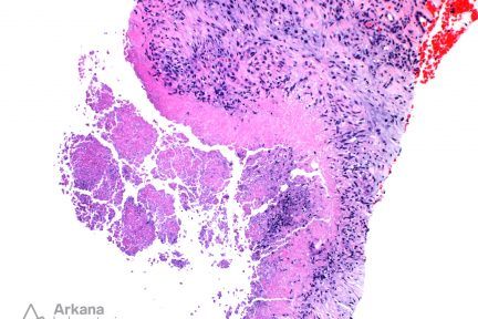 Caseating Granuloma