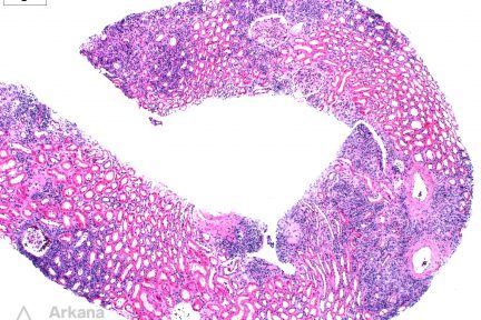 IgG4-Related Tubulointerstitial Nephritis