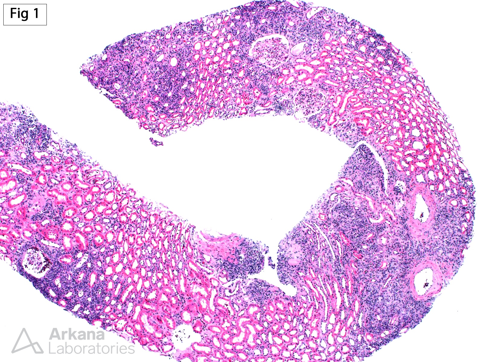 IgG4-Related Tubulointerstitial Nephritis