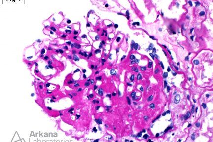 APOL1 risk alleles, IgA and APOL1-Associated Nephropathy