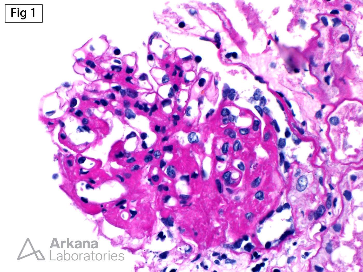 APOL1 risk alleles, IgA and APOL1-Associated Nephropathy