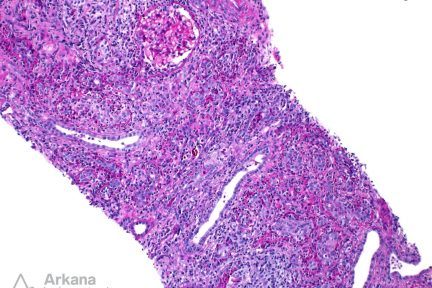 Chronic Active Tubulointerstitial Nephritis