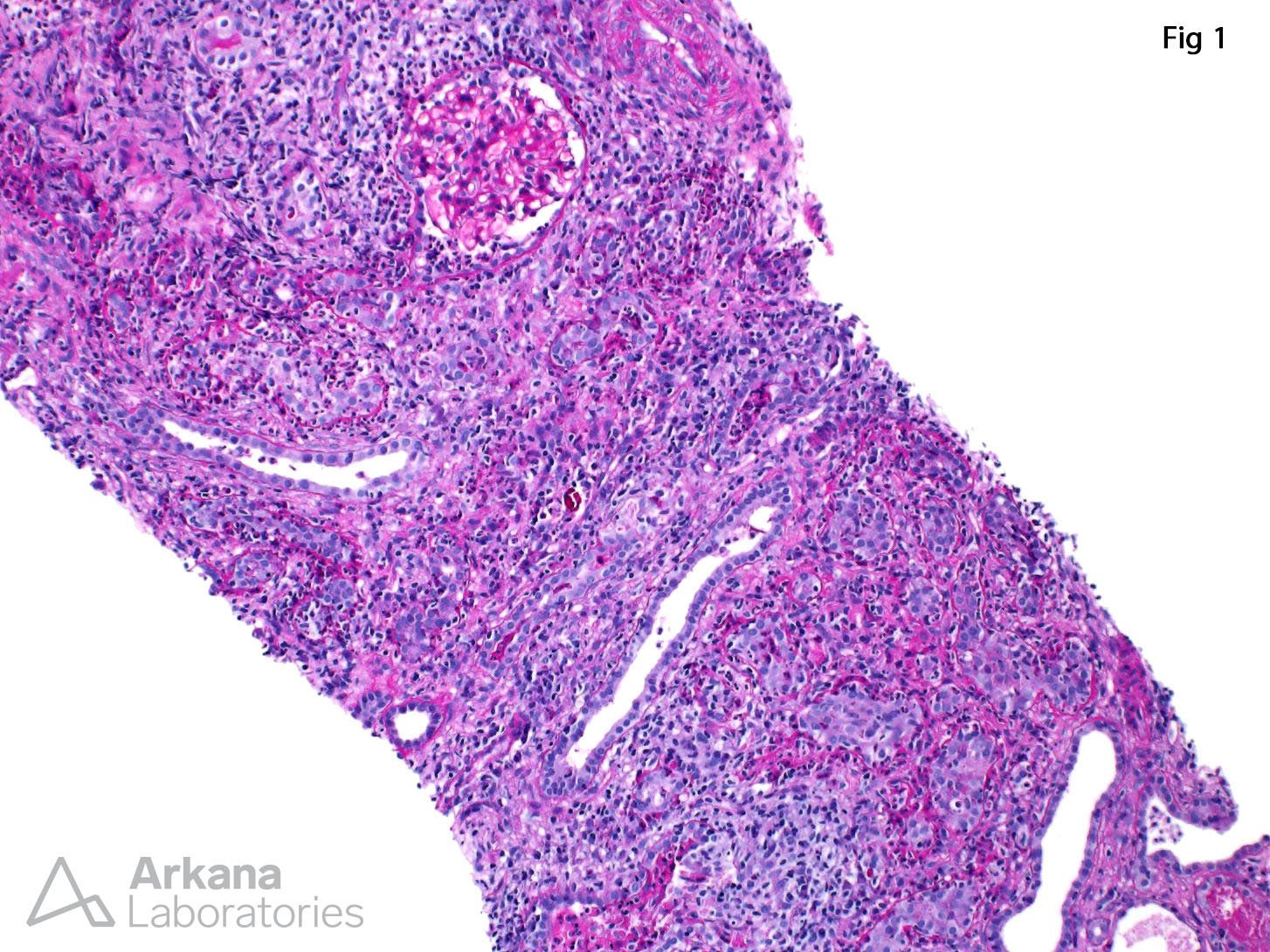 Chronic Active Tubulointerstitial Nephritis