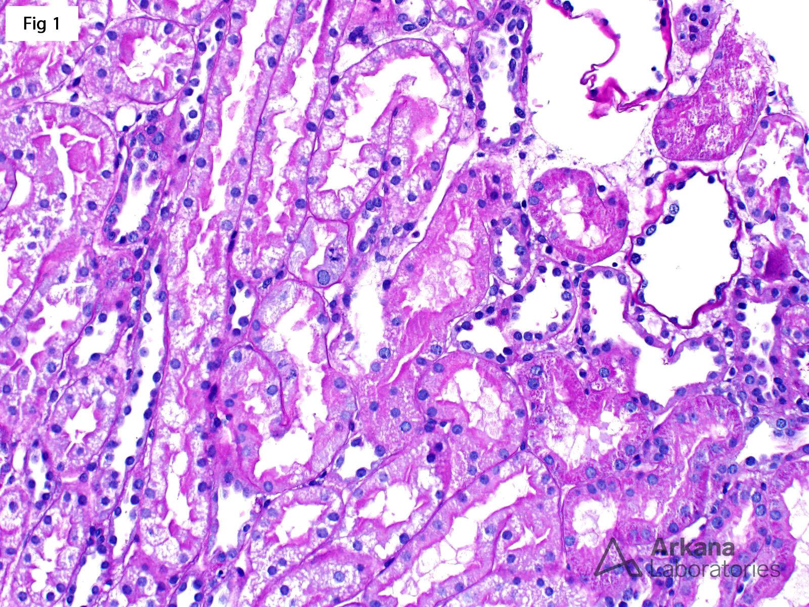 AKI, MCD, renal injury