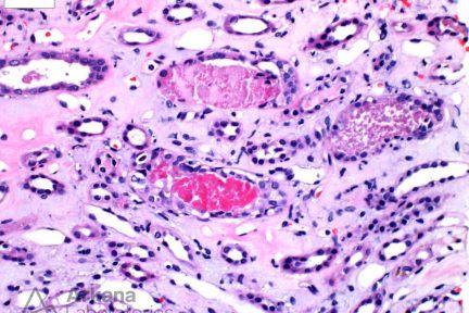 Acute Tubular Injury, globular retractile brightly eosinophilic and fuchsinophilic casts,