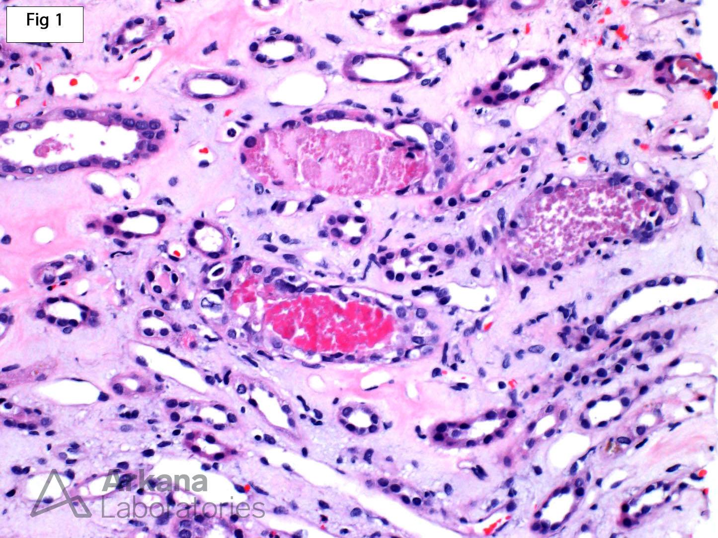 Acute Tubular Injury, globular retractile brightly eosinophilic and fuchsinophilic casts,