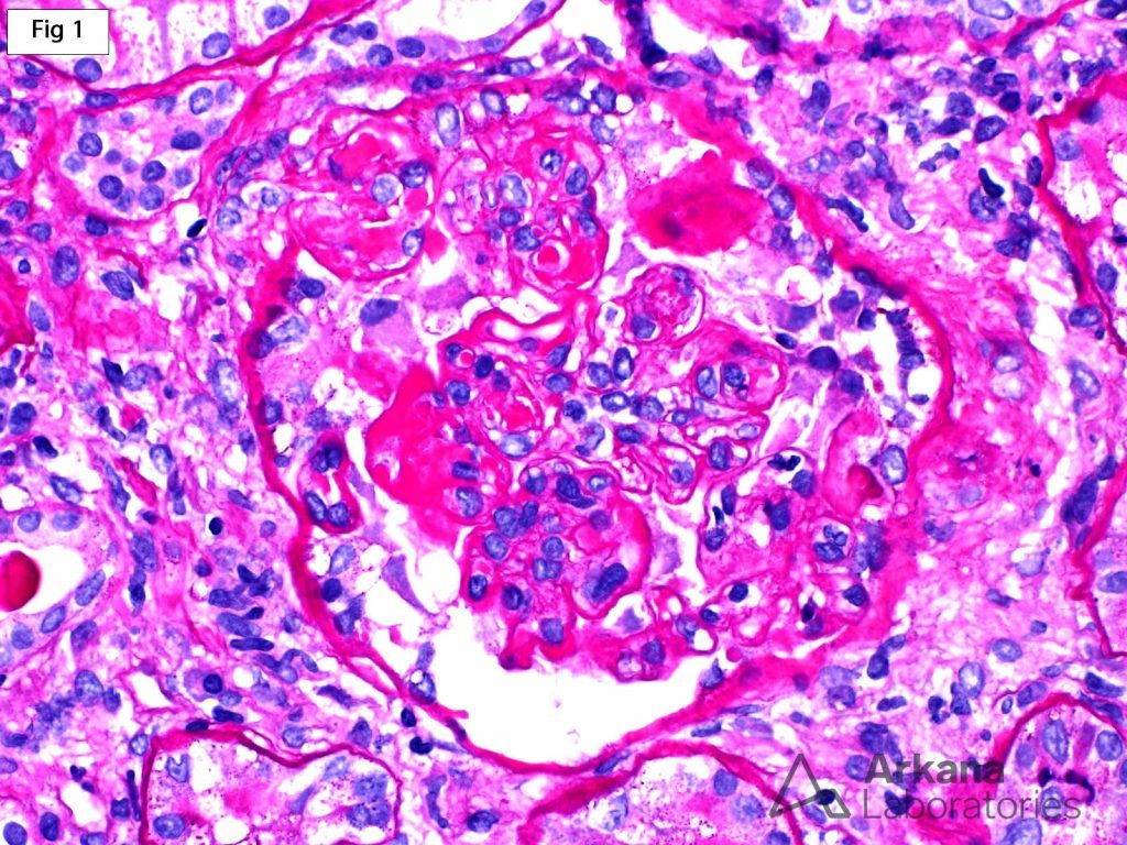 Subepithelial Deposits in Lupus Nephritis