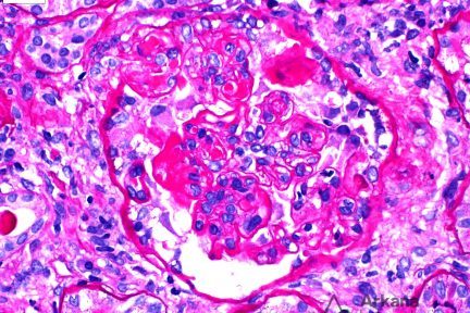 Subepithelial Deposits in Lupus Nephritis