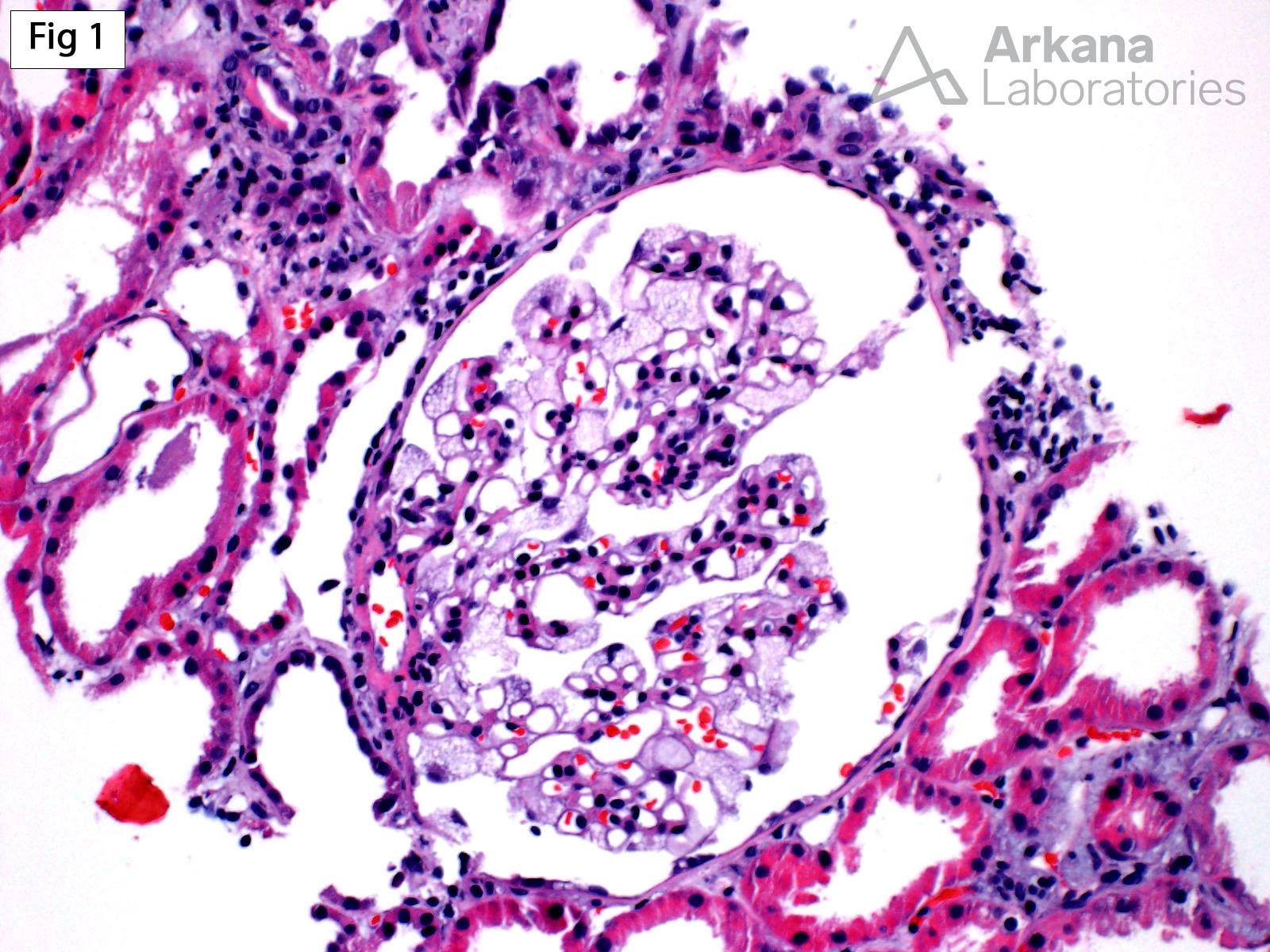 Fabry disease