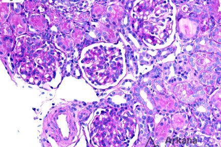 Congenital Nephrotic Syndrome