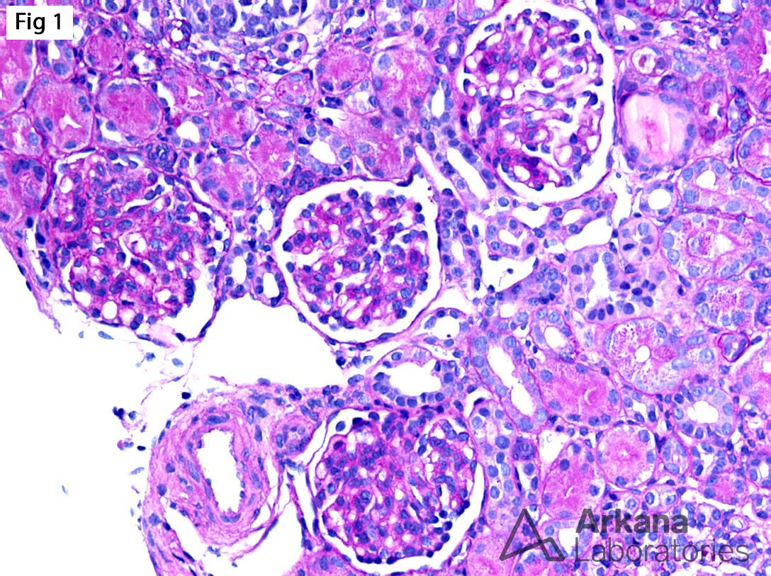 Congenital Nephrotic Syndrome