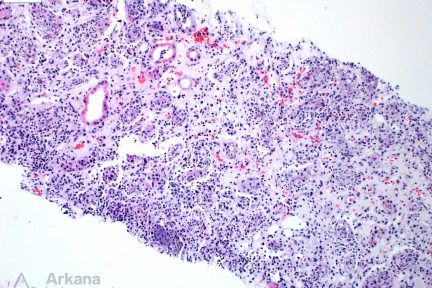 Acute Pyelonephritis