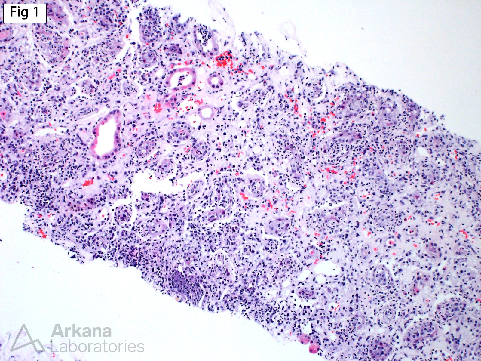 Acute Pyelonephritis