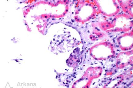 focal and segmental necrotizing and crescentic lesions, Infective Endocarditis-Associated Glomerulonephritis