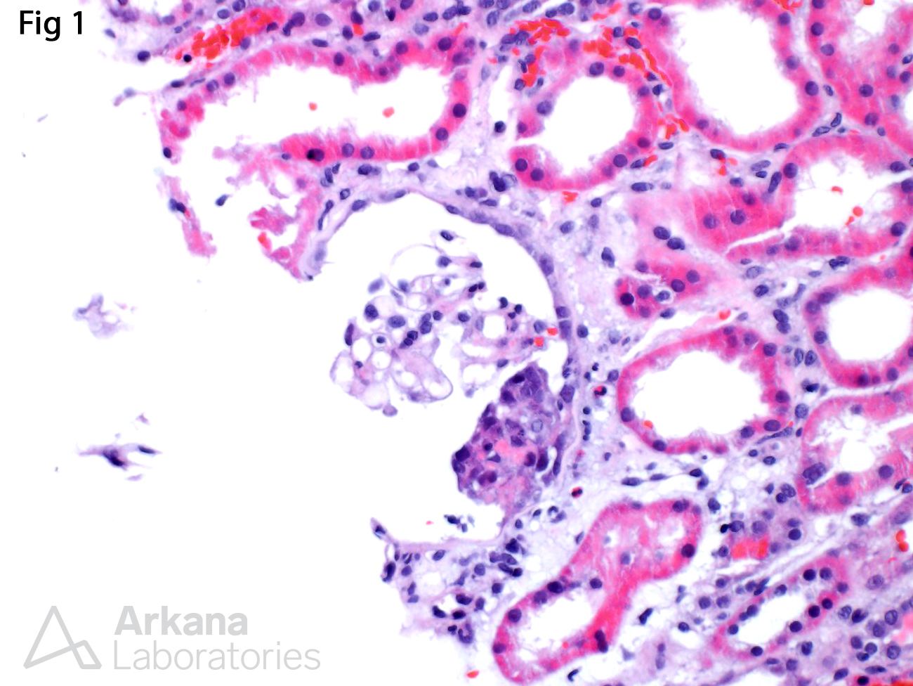 focal and segmental necrotizing and crescentic lesions, Infective Endocarditis-Associated Glomerulonephritis