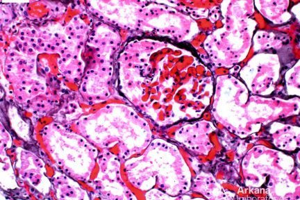 renal vein thrombosis