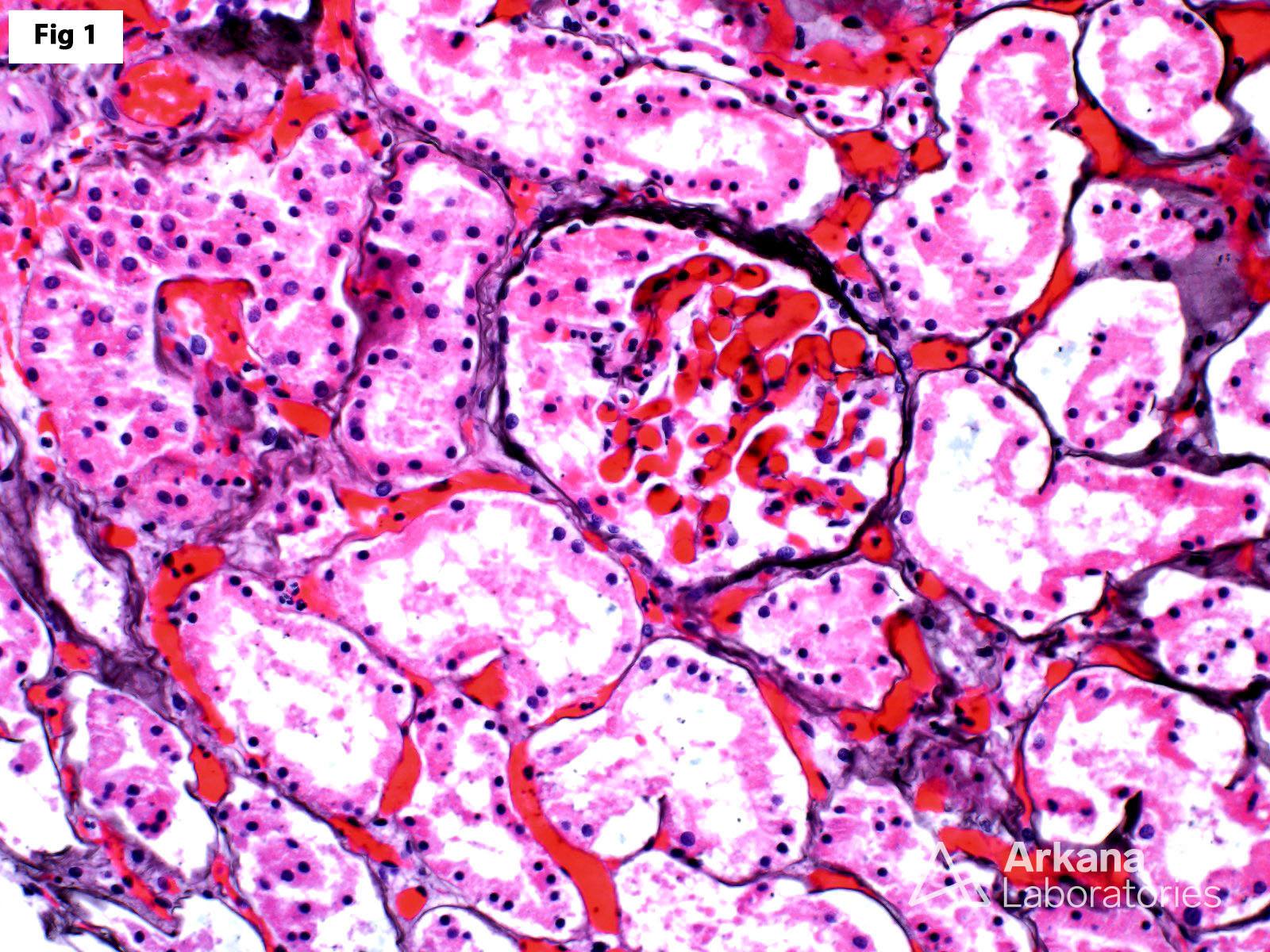 renal vein thrombosis