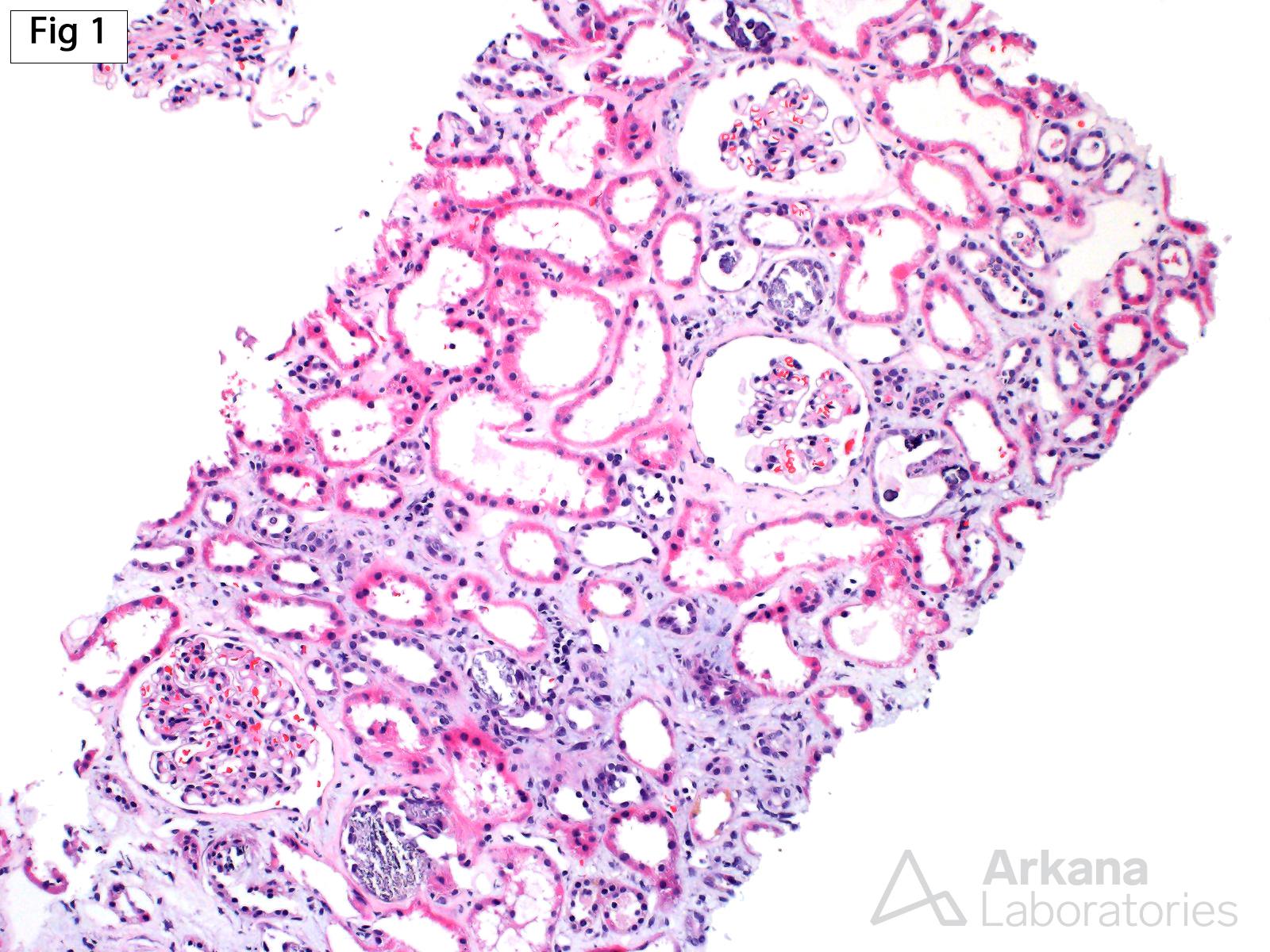 Calcium Phosphate Deposits