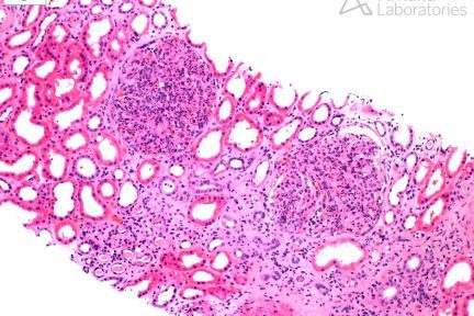 Masked Paraprotein-Related Glomerulonephritis