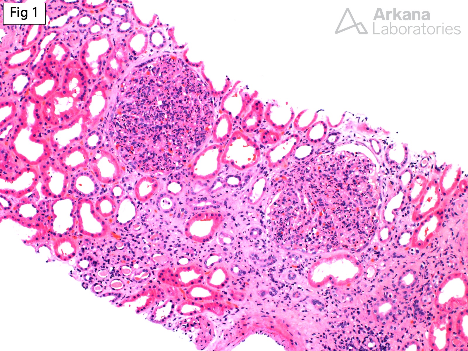 Masked Paraprotein-Related Glomerulonephritis