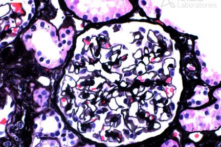 Apolipoprotein A-IV Amyloidosis