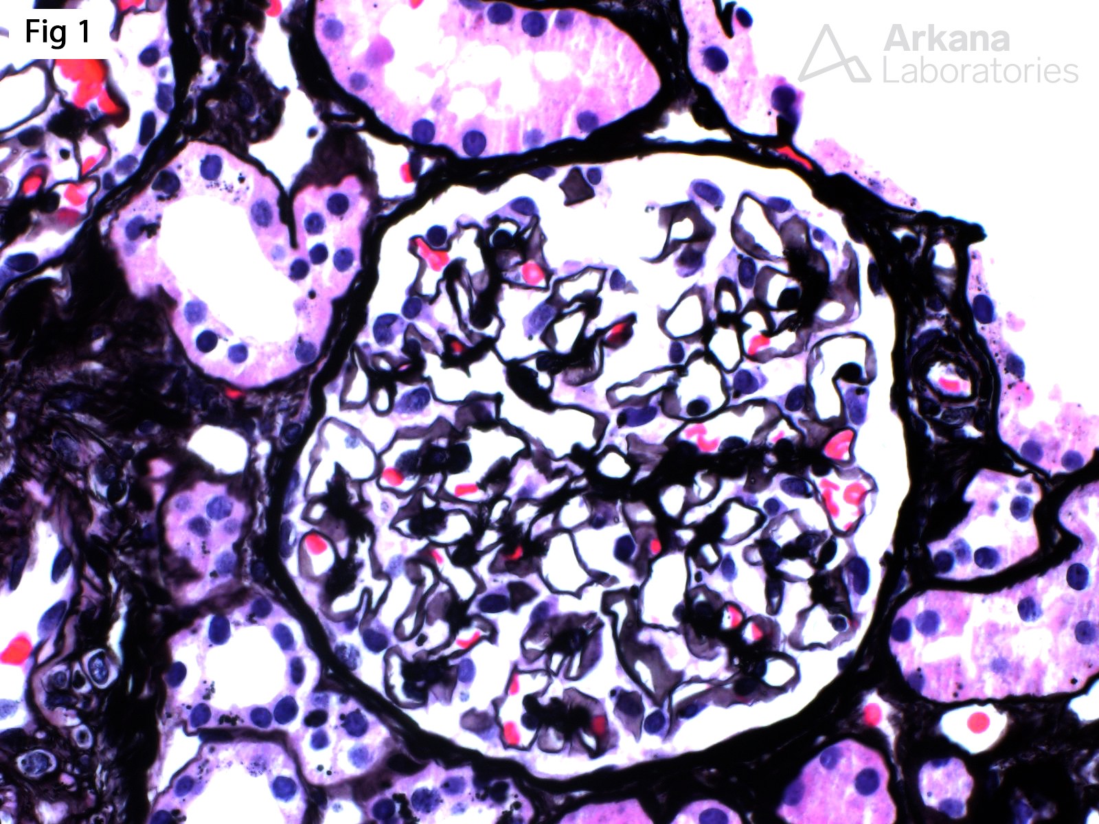 Apolipoprotein A-IV Amyloidosis