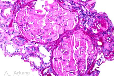 Fibrinogen Aα-chain Amyloidosis