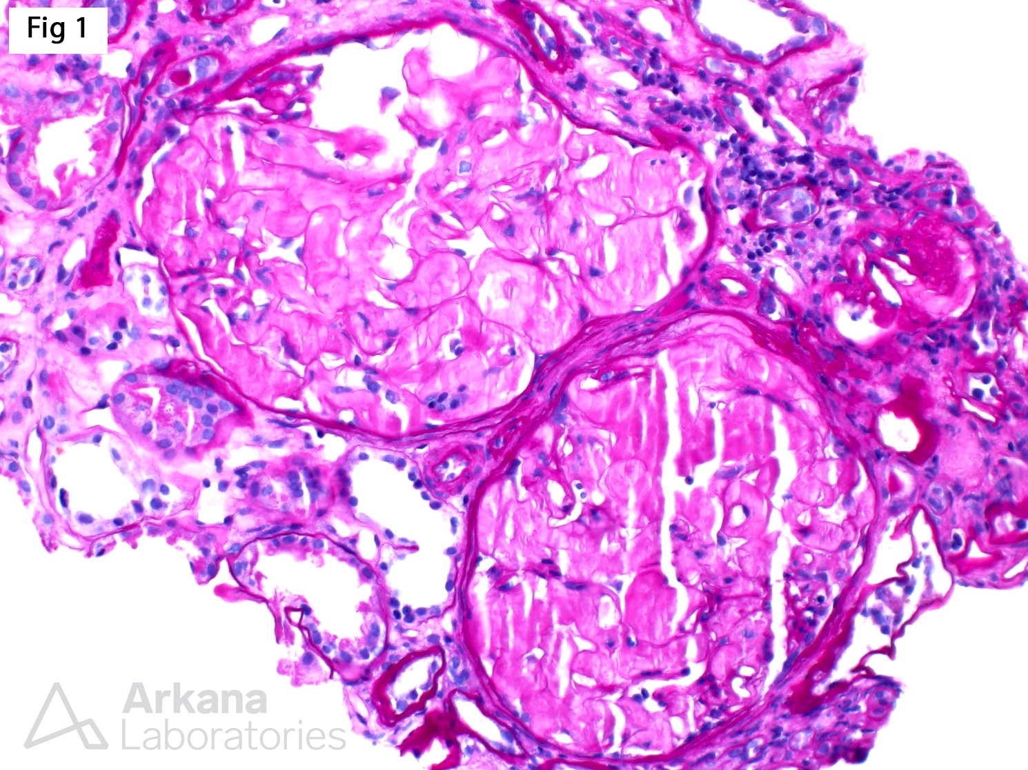 Fibrinogen Aα-chain Amyloidosis