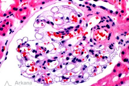 vacuolated cytoplasm, Fabry Disease in Female Carriers