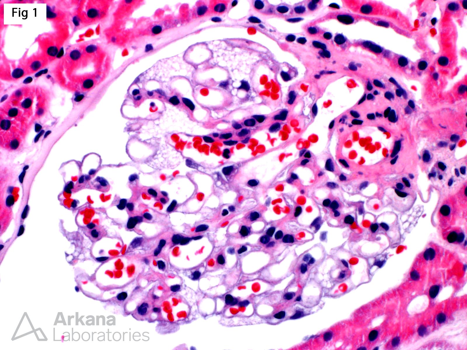 vacuolated cytoplasm, Fabry Disease in Female Carriers