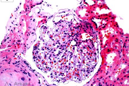 Glomerulomegaly in renal biopsy