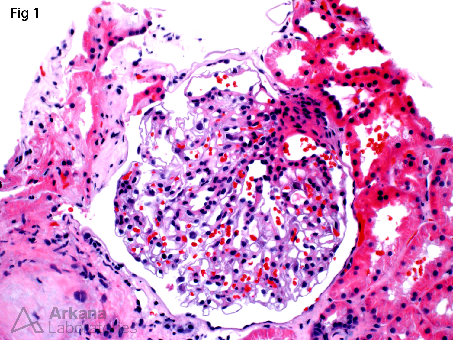 Glomerulomegaly in renal biopsy
