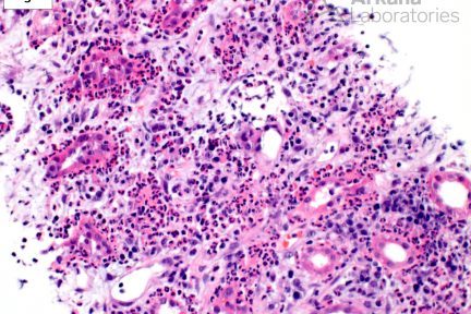 Acute Pyelonephritis