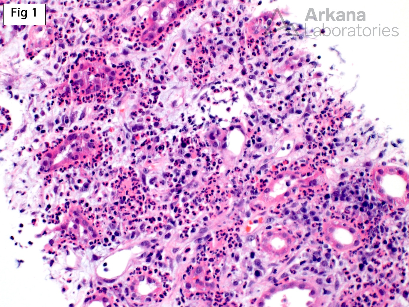 Acute Pyelonephritis