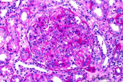 Cryoglobulinemic Glomerulonephritis