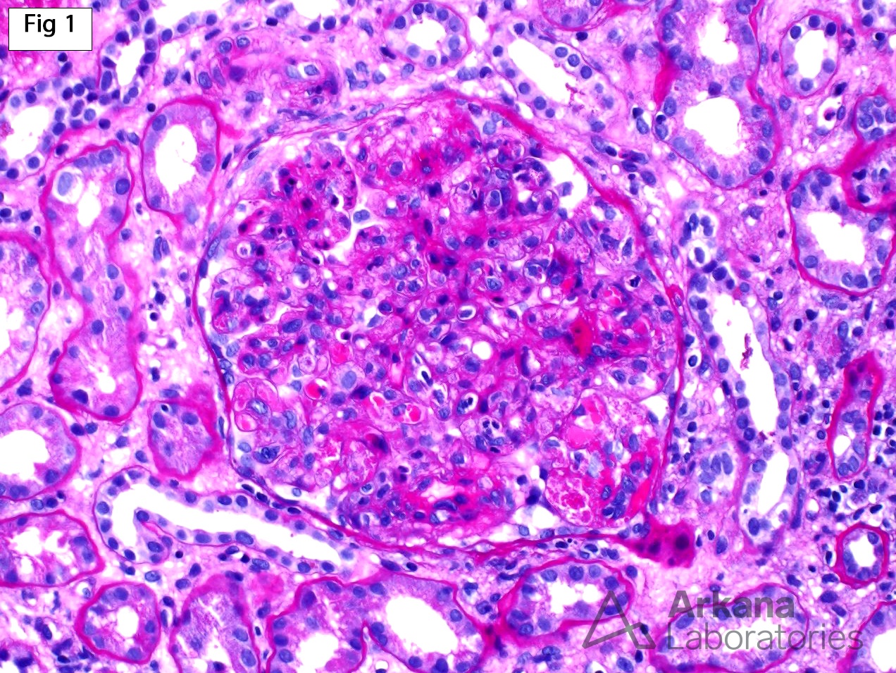 Cryoglobulinemic Glomerulonephritis