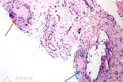 Chronic Uric Acid Nephropathy