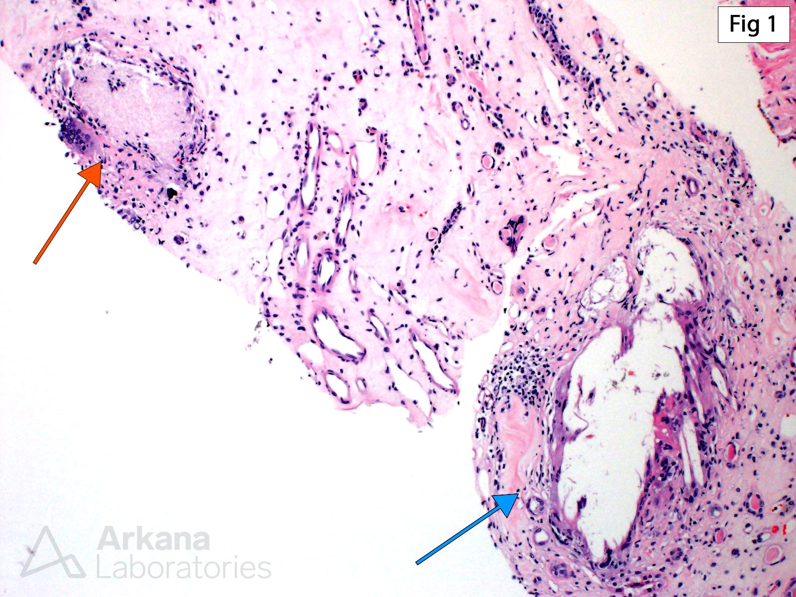 Chronic Uric Acid Nephropathy