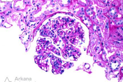 mild endocapillary hypercellularity with rare double contour formation of the capillary loops, Proliferative Glomerulonephritis with Monoclonal IgG Deposits