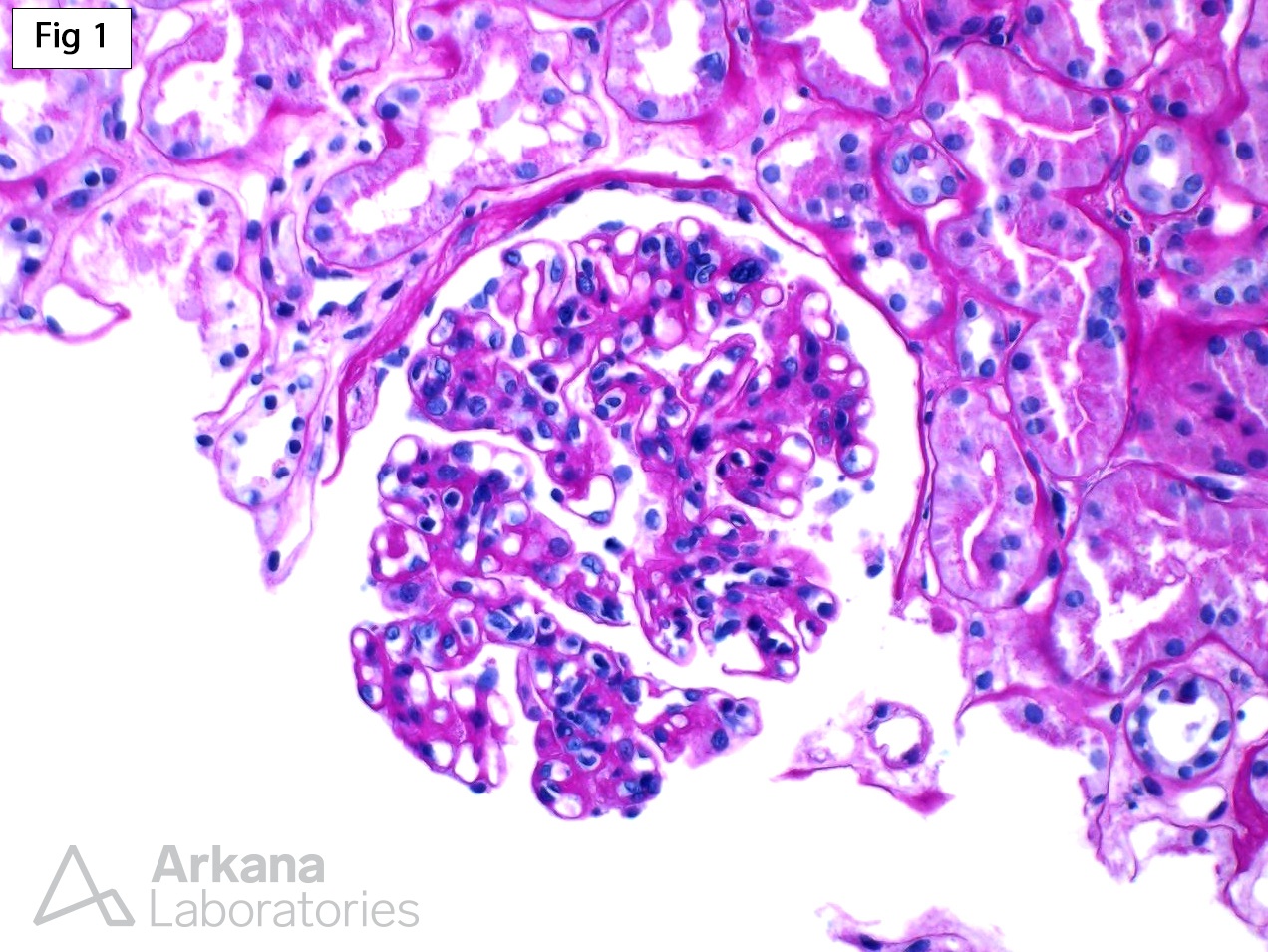 mild endocapillary hypercellularity with rare double contour formation of the capillary loops, Proliferative Glomerulonephritis with Monoclonal IgG Deposits