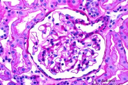 Thin Basement Membrane Disease