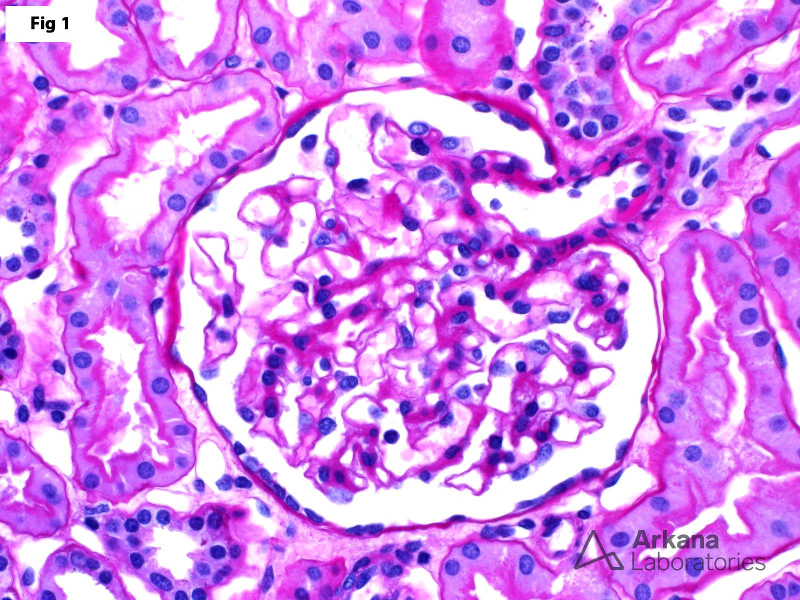 Thin Basement Membrane Disease