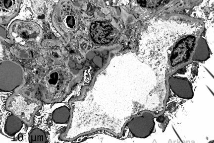 Subepithelial Humps, irregular subepithelial deposits