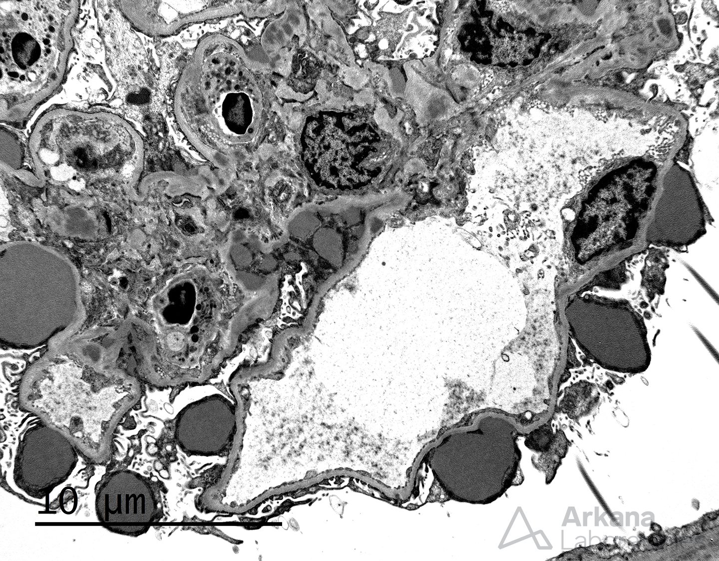 Subepithelial Humps, irregular subepithelial deposits