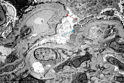 persistent proteinuria, membranous glomerulopathy